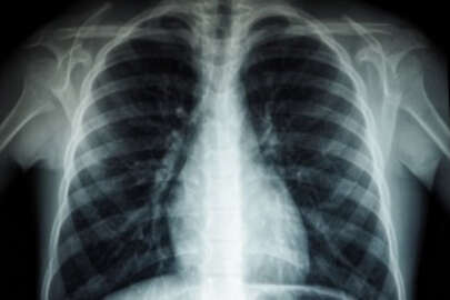 Düşük maliyetli bir ilacın Kovid-19 hastalarında akciğer zararını sınırladığı belirlendi