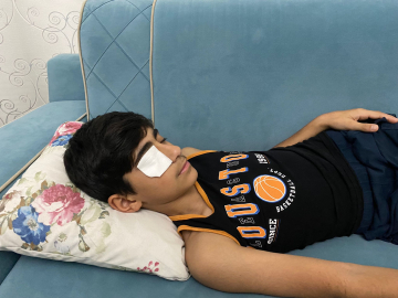 Yapıştırıcı sıçrayınca kapanan göz kapağı doktor müdahalesiyle açıldı