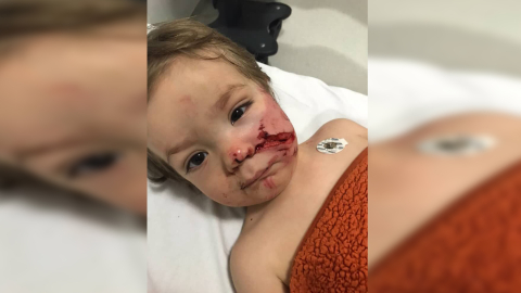 Ankara’da pitbull saldırısına uğrayan 1,5 ve 5 yaşındaki kardeşler yaralandı